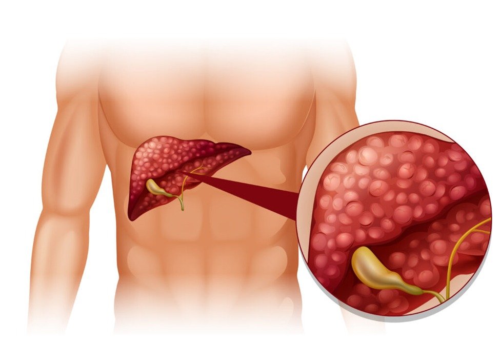 cure been found for pancreatic cancer